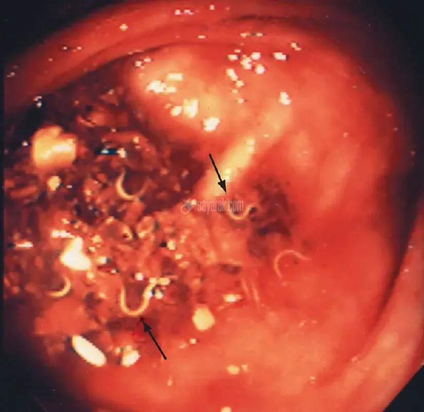 enterobius-vermicularis.jpg