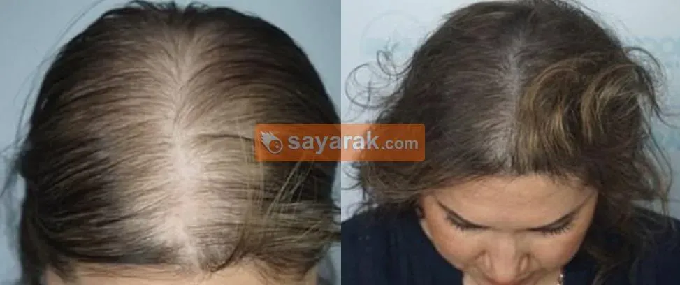 پوشاندن نواحی کچلی در سر