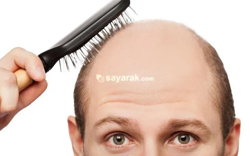 چه غذا هایی باعث ریزش مو و طاسی می شود