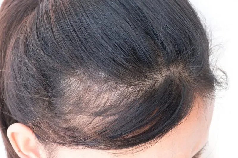 خطر طاسی در قرنطینه